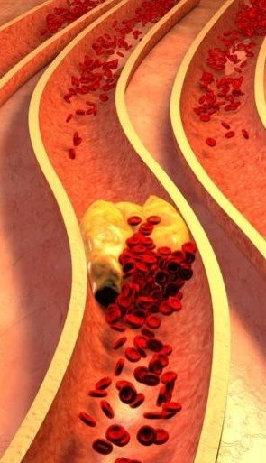 inflammation